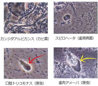 歯周病の原因菌